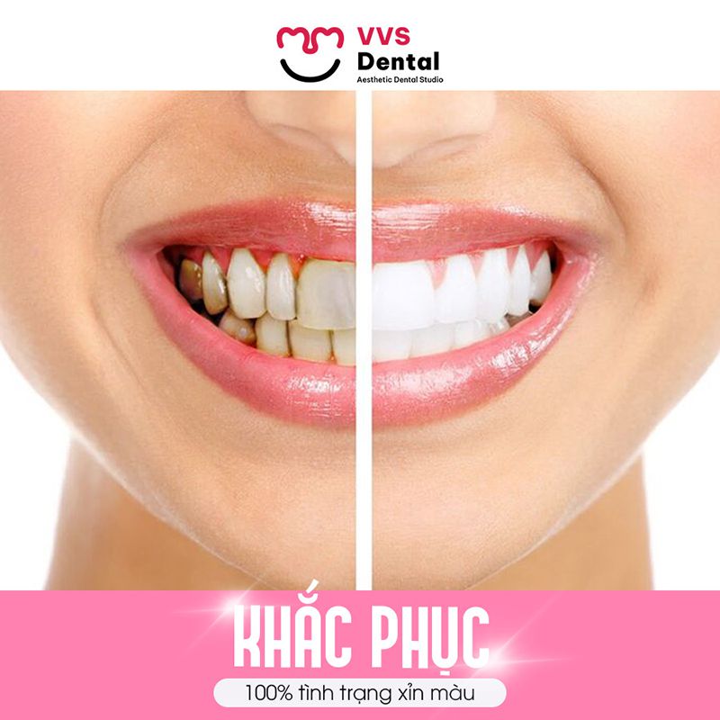 răng thưa nên niềng hay bọc sứ