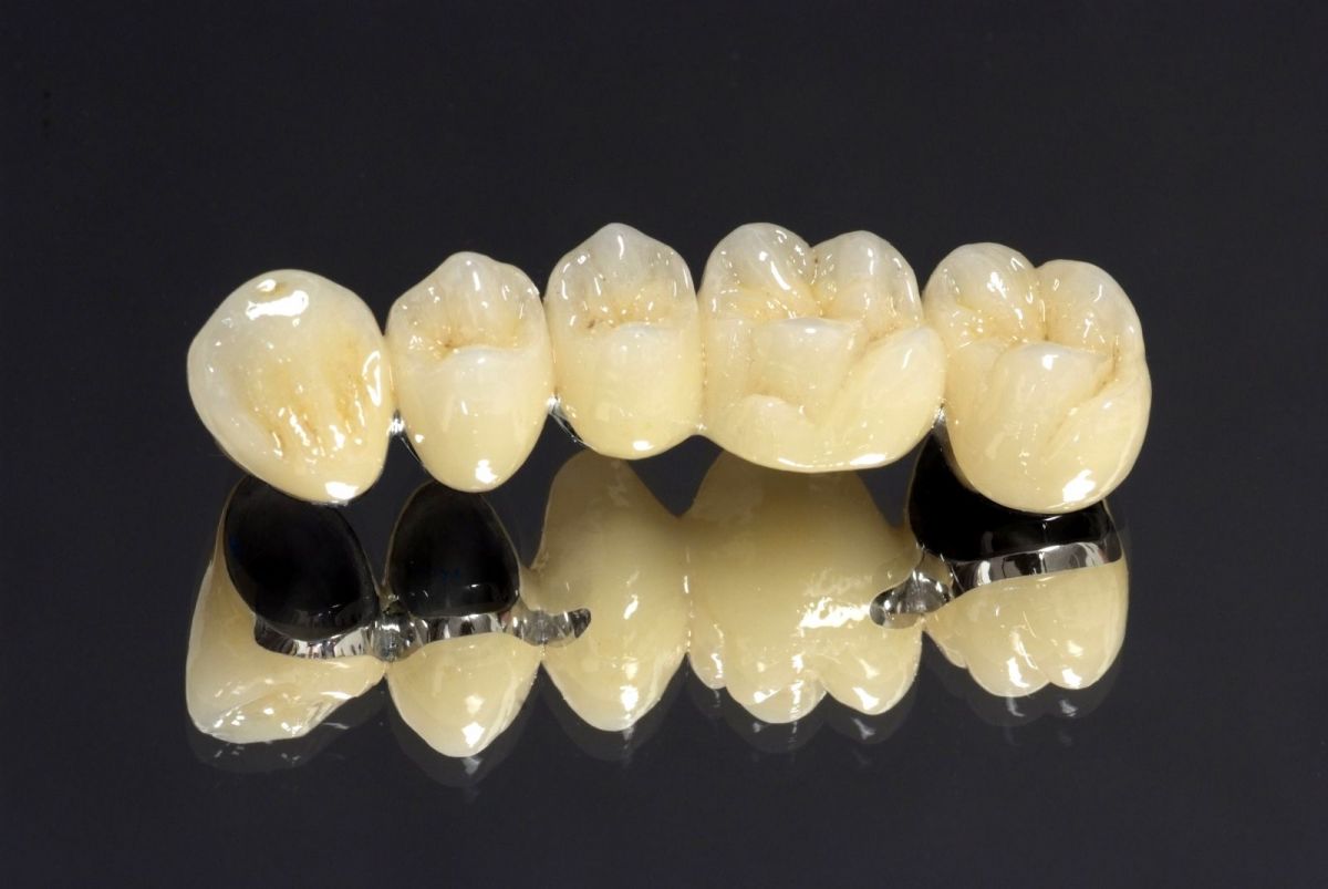 tác hại của răng sứ kim loại