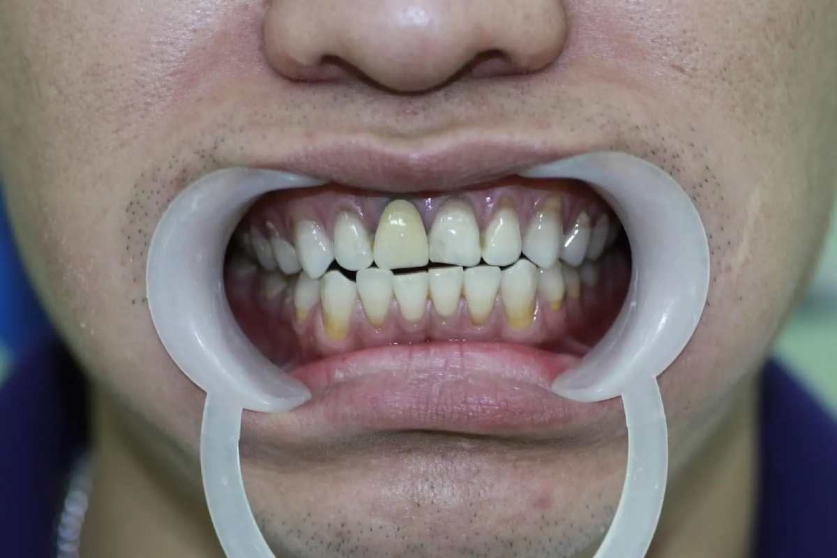 tác hại của răng sứ kim loại