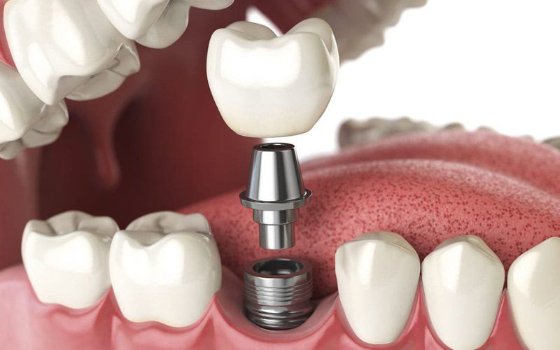 trồng răng Implant ở đâu tốt TPHCM